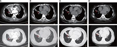 Case report: Dramatic response to alectinib in a lung adenosquamous carcinoma patient harbouring a novel CPE-ALK fusion